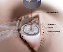 IS LASIK IS ALLOWED IN INDIAN NAVY?